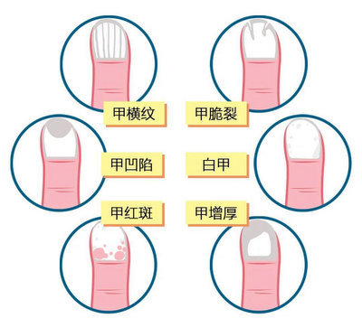 银屑病甲